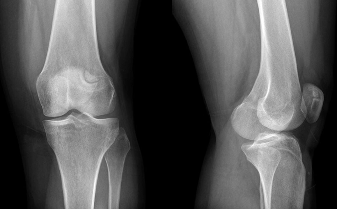 Hondroin kullanımından önce dizinin x -ray üzerindeki eklem artrozu