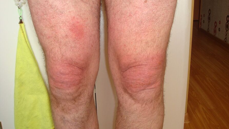 diz eklemlerinin artrozu